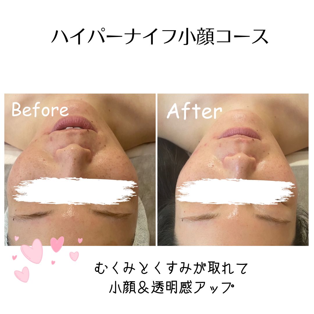 ハイパーナイフフェイシャルハイパーナイフフェイシャルプロップ