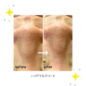 お肌がザラザラ・・していませんか？